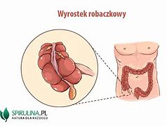 Image result for co_to_znaczy_zapalenie_wyrostka_robaczkowego