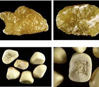 Image result for Cystine Stones