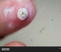 Image result for White Wart