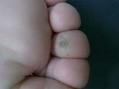 Image result for Plantar Wart On Foot