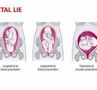 Image result for Transverse Lie Baby
