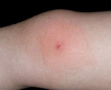 Image result for Molluscum Contagiosum Causes and Treatment