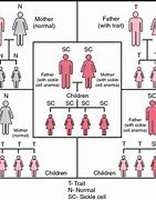 Image result for Heterozygous Sickle Cell