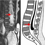 Image result for Caudal Regression Syndrome