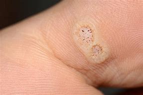 Image result for Papilloma On Foot