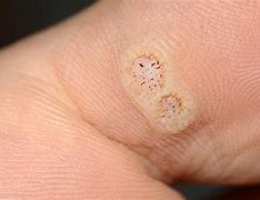 Image result for Cutaneous Human Papillomavirus Infections