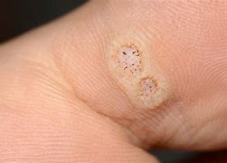 Image result for Human Papillomavirus Flat Warts