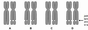 Image result for co_to_za_zespół_Łamliwego_chromosomu_x