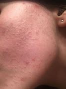 Image result for Flesh-Colored Bumps On Cheeks