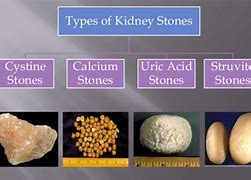 Image result for What Do Kidney Stones Look Like