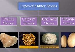 Image result for Kidney Stone Color