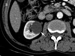 Image result for Renal Cyst Ultrasound