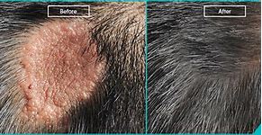 Image result for Syphilis Hair Loss