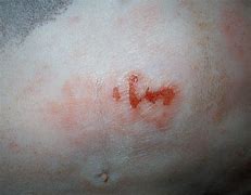 Image result for Excoriation Skin Lesion
