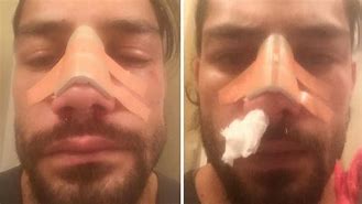 Image result for Roman Reigns Nose Job