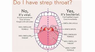 Image result for Viral Vs. Bacterial Strep