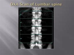 Image result for Bone Density Lumbar Spine