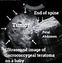 Image result for What Is a Teratoma Tumor