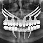 Image result for Zygomatic Implants CT Scan