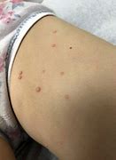 Image result for Inflamed Molluscum Contagiosum