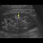 Image result for Renal Ultrasound Kidney Stones