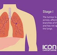 Image result for 4 Stages of Lung Cancer