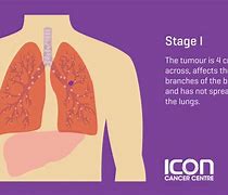 Image result for 4 Types of Lung Cancer