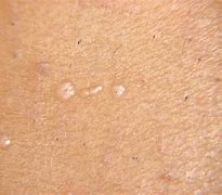 Image result for Wart Removal From Palm of Hand