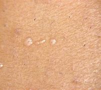 Image result for Skin Wart Removal
