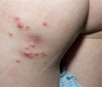 Image result for Molluscum Eczema