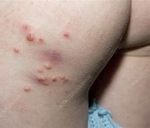 Image result for Skin Virus Molluscum Contagiosum