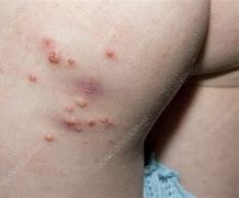 Image result for Molluscum Contagiosum and Eczema
