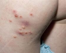 Image result for Bumps On Kids Skin Molluscum