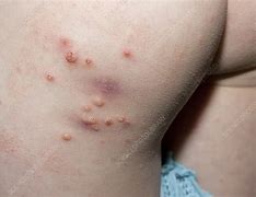 Image result for Molluscum Contagiosum in Gluteal Fold Treatment