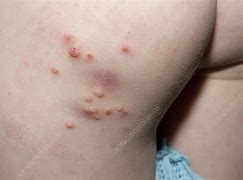 Image result for Infectious Molluscum