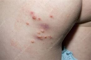 Image result for Molluscum Contagiosum Virus Infection Epidemiology