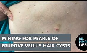 Image result for Eruptive Vellus Hair Cysts to Steotocystoma