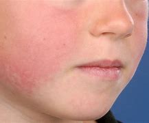 Image result for Fifth Disease Infectious