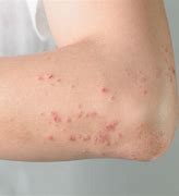 Image result for Skin Rash On Body