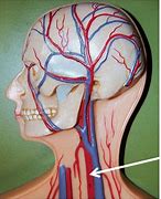 Image result for Right Carotid Artery