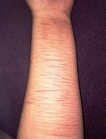 Image result for Scars On Wrist