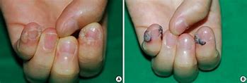 Image result for Warts Removal Before and After