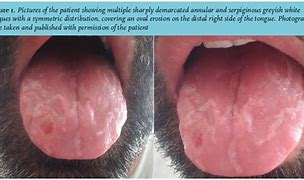 Image result for Venereal Disease Pictures in Male