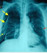 Image result for Left Side Pneumothorax