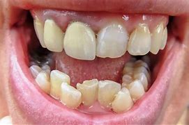 Image result for Inside Cricket Teeth