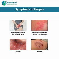Image result for Genital Herpes