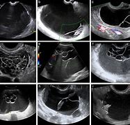 Image result for Mucinous Ovarian Cyst Ultrasound