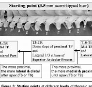 Image result for Thoracic Spine Pedicle Screw Placement
