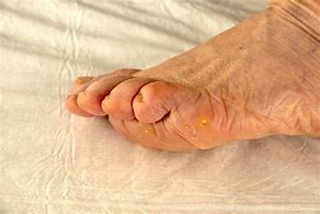 Image result for Wart On Leg