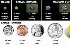 Image result for How Big Is 5 mm Tumor